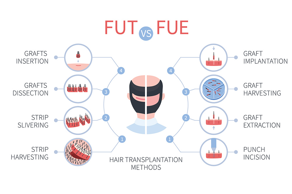 FUE vs FUT Success Rate | FUE vs FUT Hair Transplant | FUE or FUT