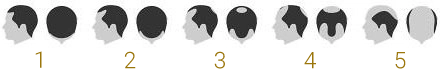baldness scale