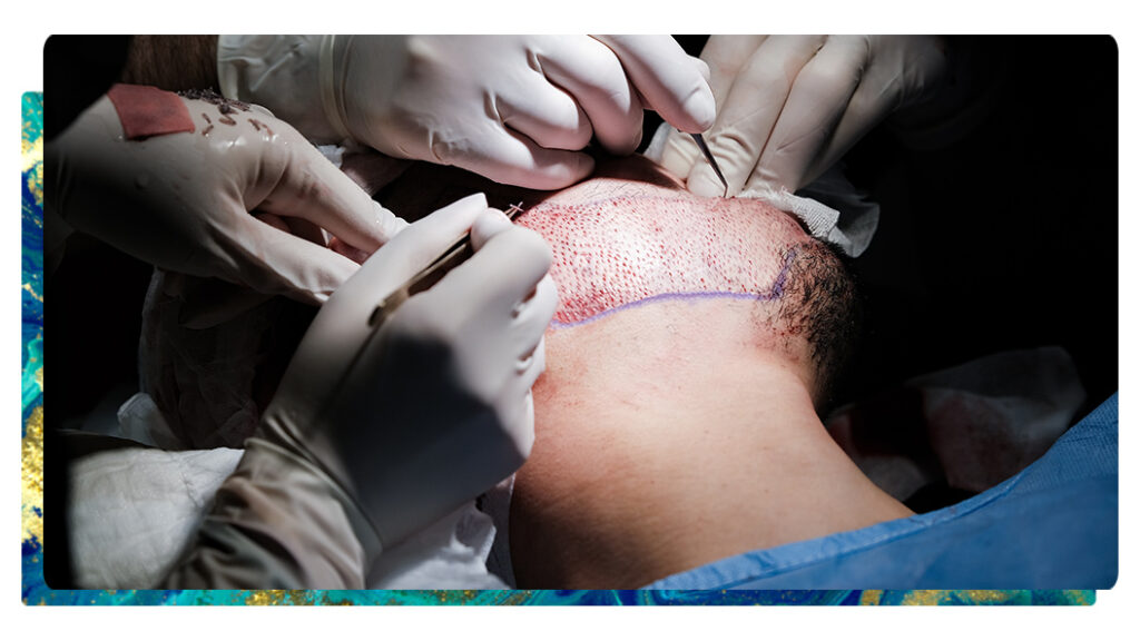 beard hair transplant, beard restoration, patchy beard correction